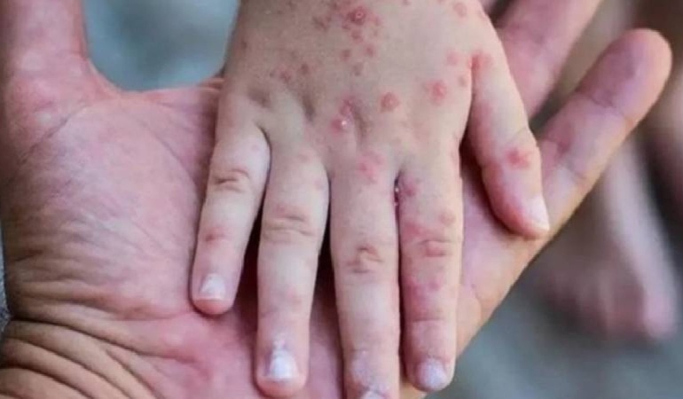 Güney Afrika’da son 5 haftada 13 m çiçeği vakası kaydedildi